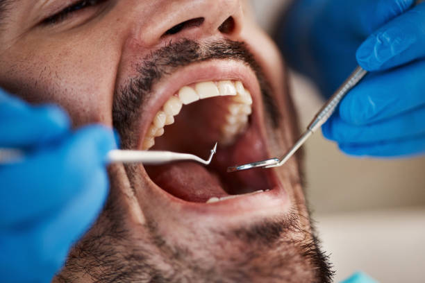 Best Broken or Cracked Tooth Emergency Dentist in St James City, FL